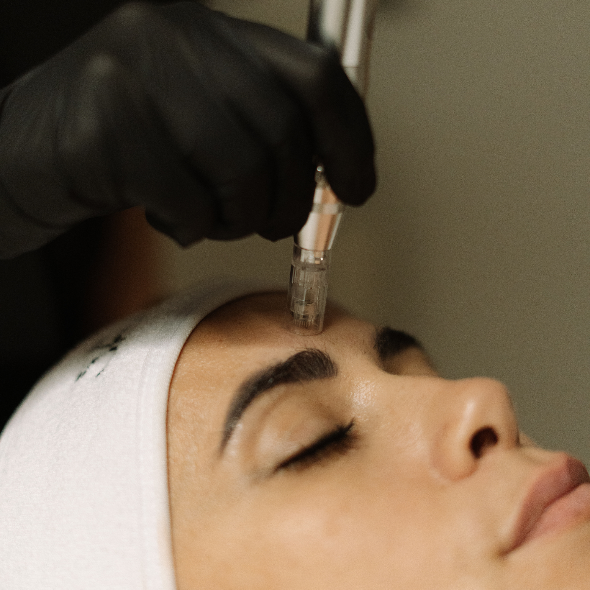Microneedling con Exosomas